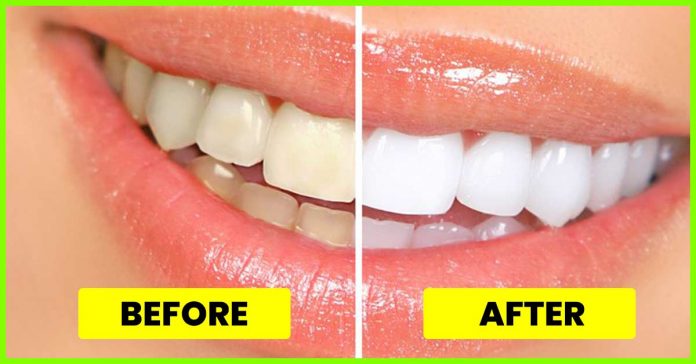 How to whiten teeth?