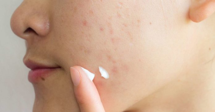 How to remove pimple marks
