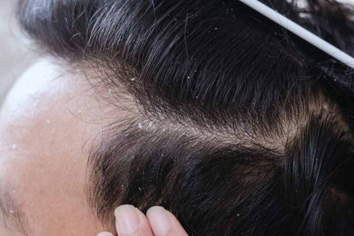 How to get rid of dandruff?
