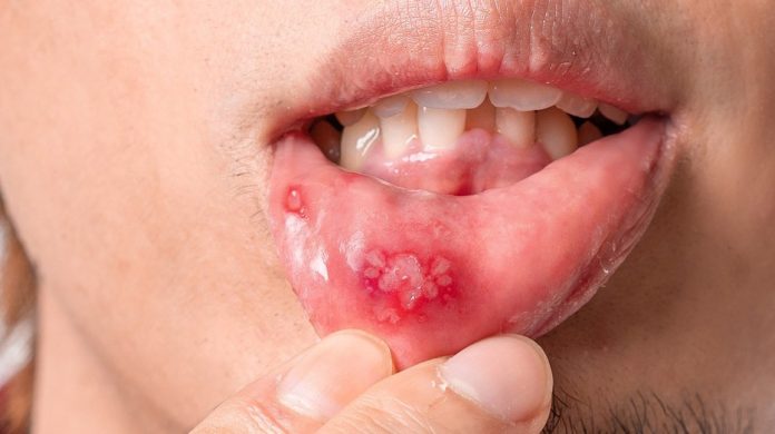 How to get rid of a canker sore?